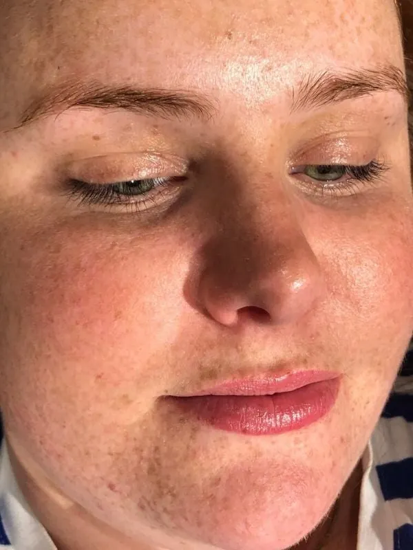 Brow Lamination Side Effects on Acne-Prone Skin