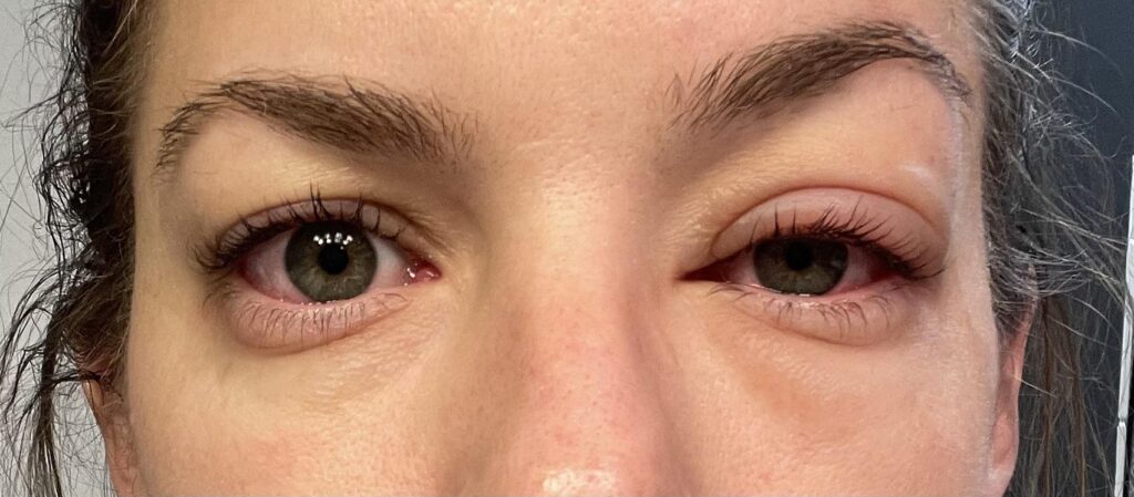 Myth 2 – Lash Lifts Hurt or Burn